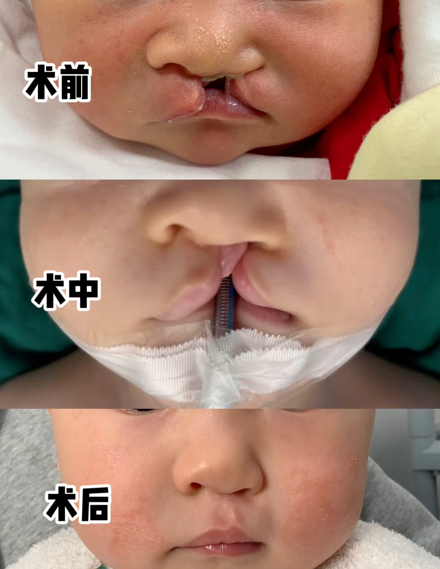 对话口腔颌面外科专家陈亦阳：唇腭裂没那么可怕，规范治疗后可与常人无异 | 嫣然医院欠租风波背后