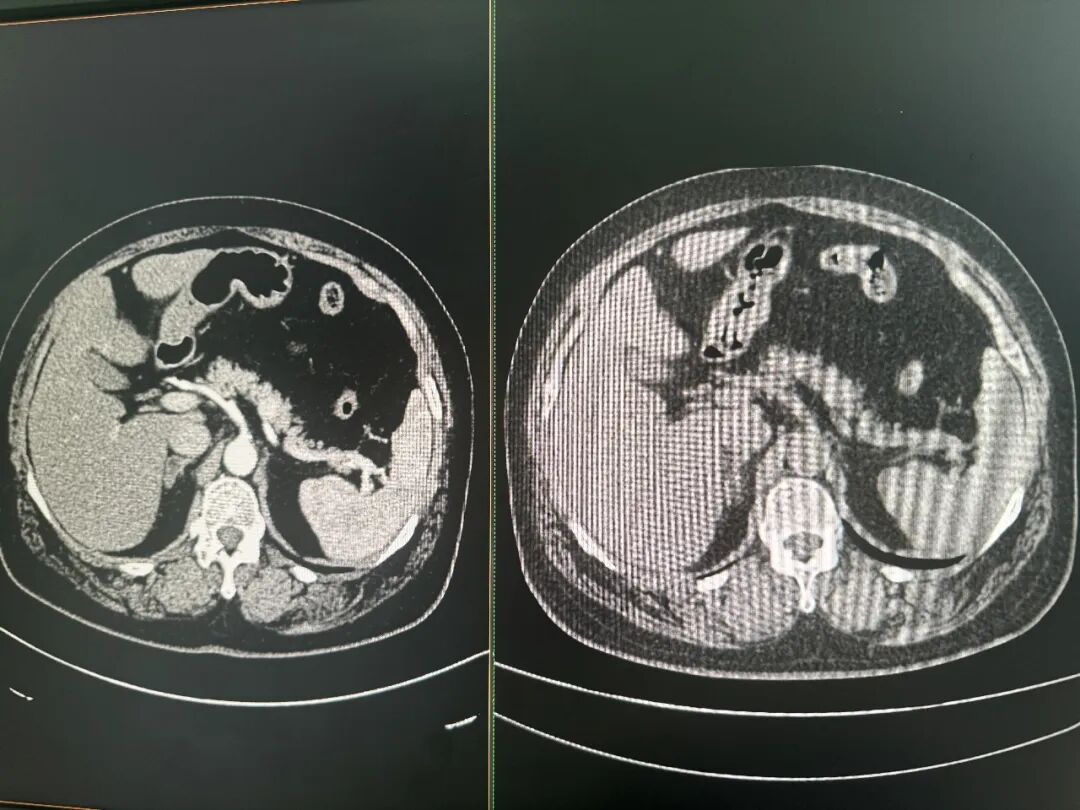 检查糖尿病却查出胰腺癌！仅凭百元CT揪出“癌症之王”，医生没看出来的病，AI是怎么发现的？